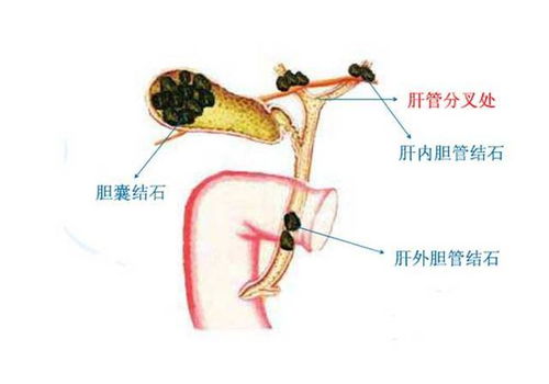 胆管结石健康指导