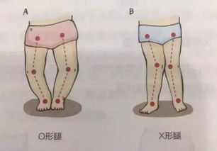 儿童骨头闭合图片