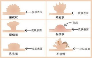 尖锐湿疣反复发作怎么办 做过电灼 输液等治疗但是效果不佳