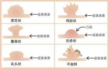 治愈尖锐湿疣必看:哪些药物能快速缓解症状