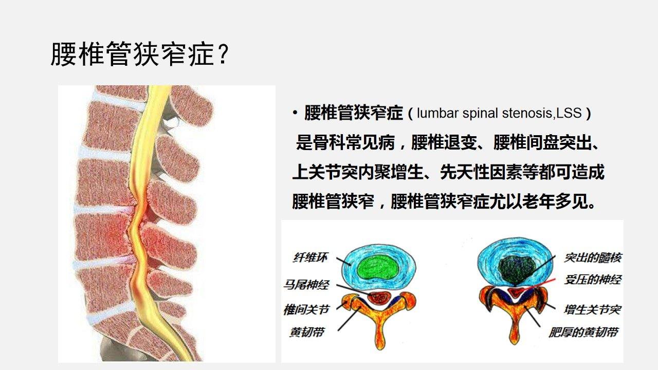 腰椎管狭窄症究竟是什么？又有哪些症状