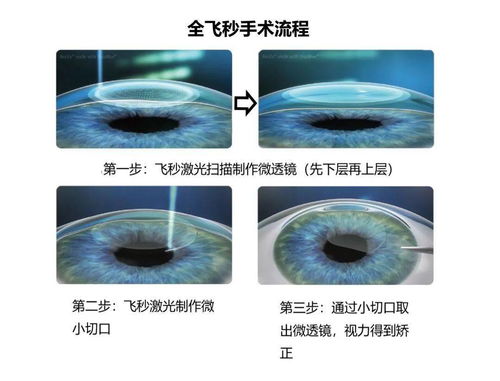 激光近视手术角膜的安全厚度多少