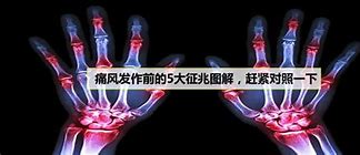 关注痛风，远离痛疯科学管理与预防策略