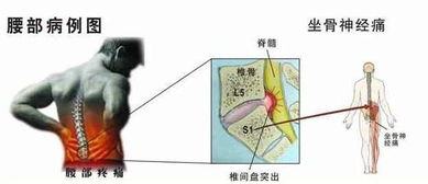 **日常动作的隐形杀手揭秘腰椎间盘突出的潜在风险**