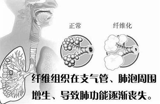 肺癌病情