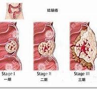 慢性肠炎症状、管理与生活质量的提升