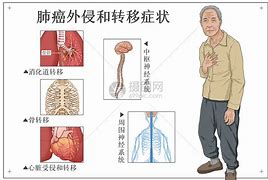 肺癌的中晚期症状有哪些