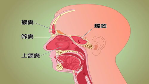 SWOT分析鼻炎的症状