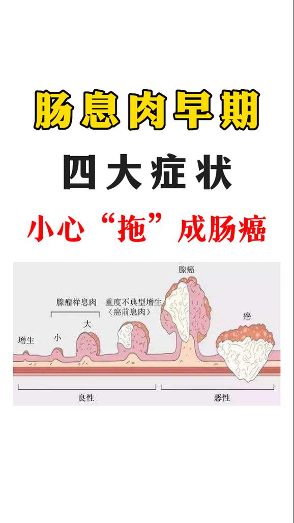 肠息肉的症状表现有哪些严重吗