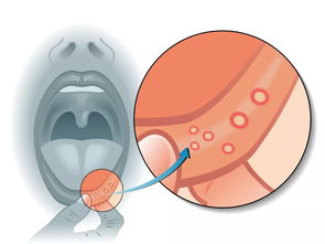 口腔癌的早期症状hpv