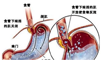 反流性食道炎的症状都有哪些